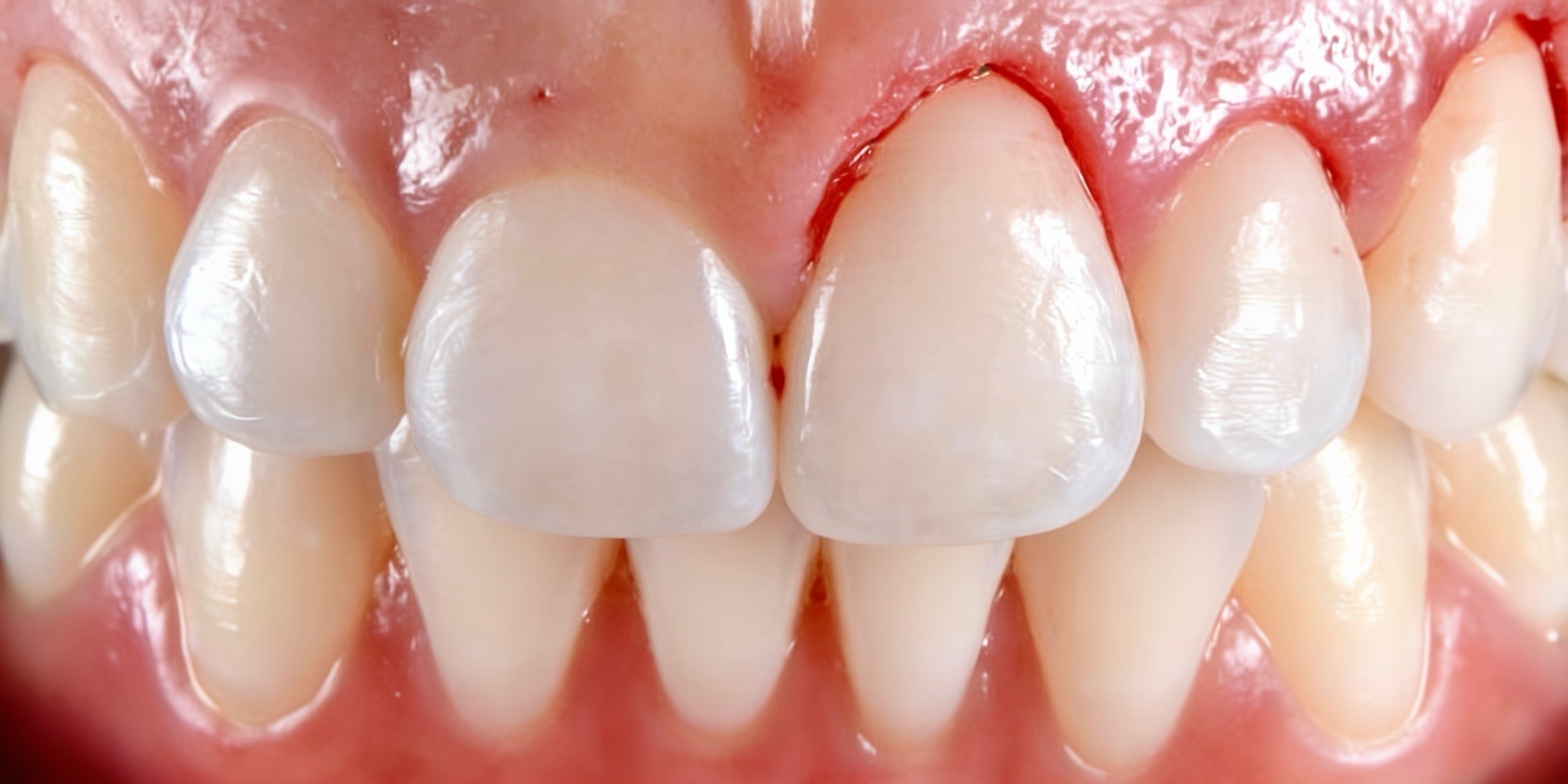 Cirurgias Periodontais — Cuidado com a gengiva e os tecidos de suporte