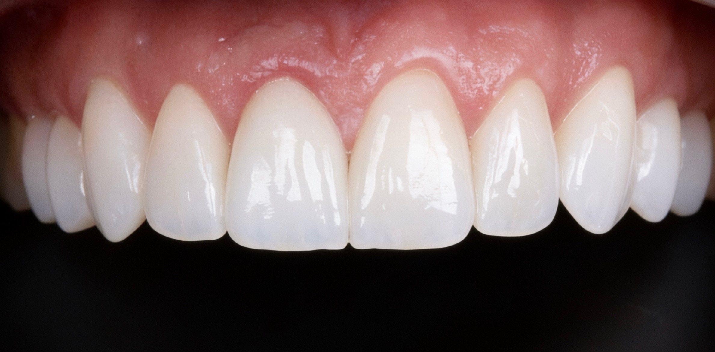 Restaurações e Coroas — Dr. Daniel Francês